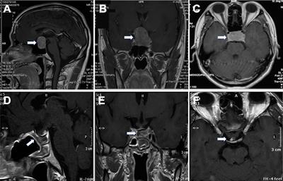 Pseudocapsule-Based Resection for Pituitary Adenomas via the Endoscopic Endonasal Approach